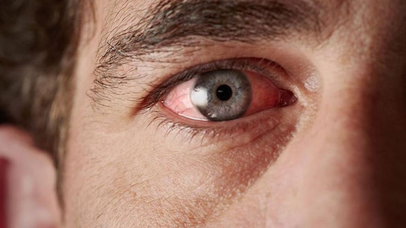 Comprehensive Guide to Treating Red Eyes Effectively
