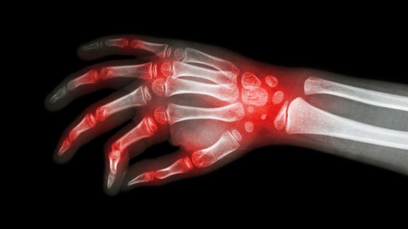 Understanding the Similarities and Differences Between Rheumatoid Arthritis and Lupus