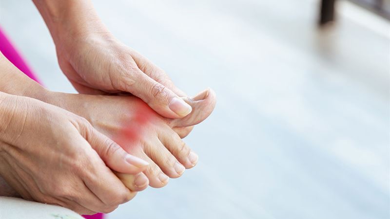 Understanding Gout: Diagnosis, Progression, and Prevention Strategies