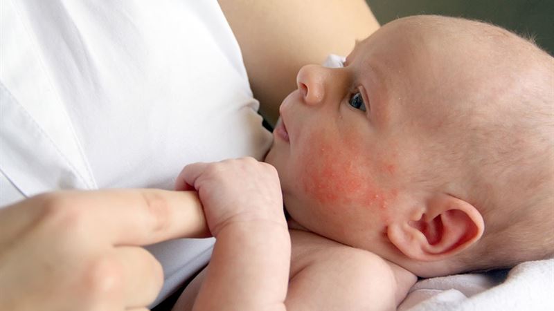Essential Tips to Prevent Common Infant Skin Problems for a Healthy, Glowing Baby Skin