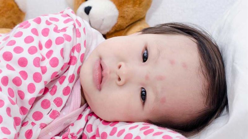 Comprehensive Guide to Recognizing and Managing Common Insect Bites