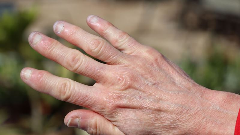 Understanding Heberden’s Nodes: Symptoms, Causes, and Effective Treatment Strategies