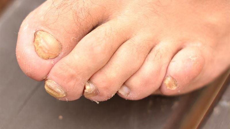 Effective Home Remedies to Eliminate Toenail Fungus Naturally