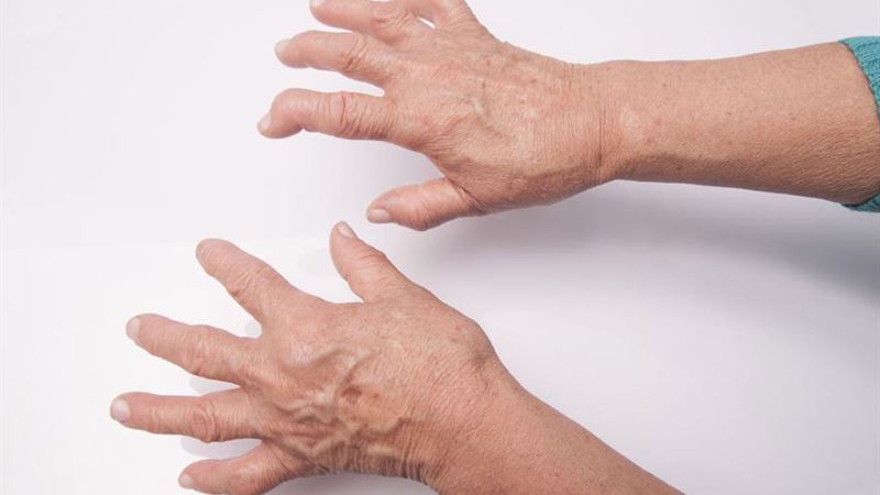 Comprehensive Guide to Managing and Treating Rheumatoid Arthritis Effectively