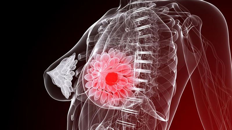Comprehensive Guide to Understanding Breast Cancer: Key Facts You Should Know