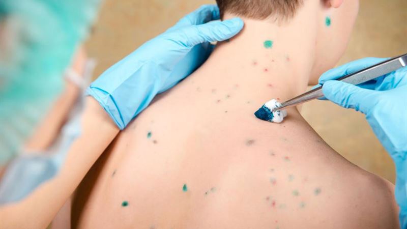 Comprehensive Guide to Skin Rashes: Causes, Types, and Effective Treatment Options