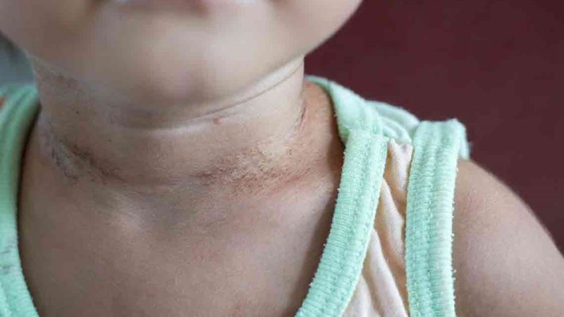 Recognizing the Early Symptoms of Lupus: A Comprehensive Guide