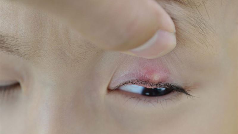 Effective Home Treatments and Natural Remedies for Blepharitis Relief