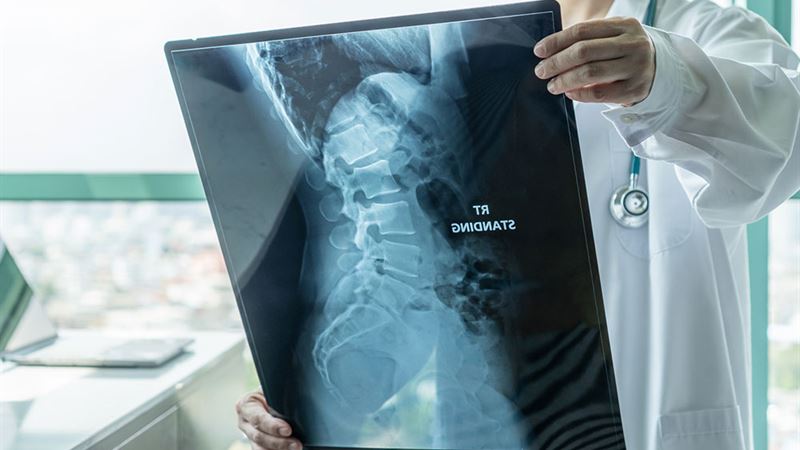 Understanding Spinal Muscular Atrophy: Types, Symptoms, and Key Facts