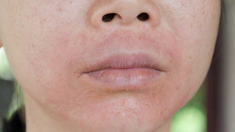 Comprehensive Approaches to Managing Cutaneous Lupus Erythematosus