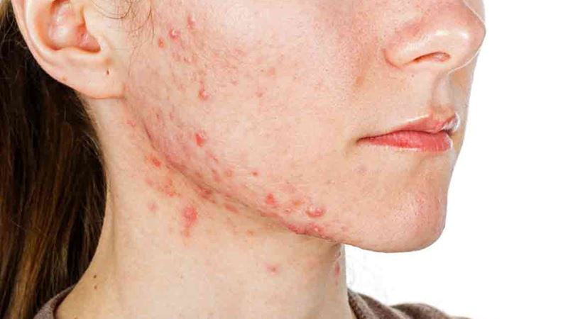 Comprehensive Guide to Recognizing Early Symptoms of Lupus Disease