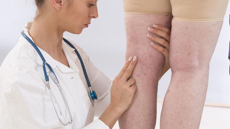 Essential Strategies to Prevent Thrombosis and Promote Vascular Health