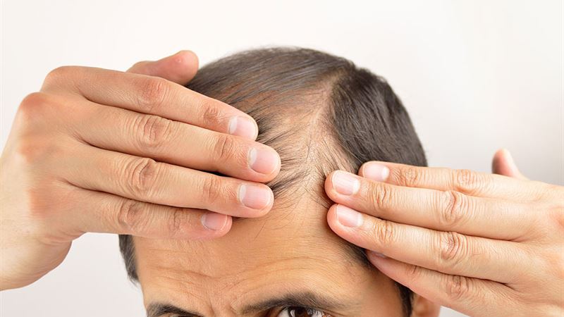 Understanding Unusual Hair Loss: The Top 4 Contributing Factors