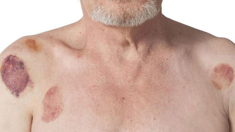 Effective Strategies for Home Management of Hematomas