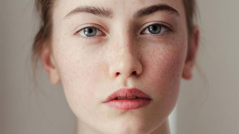 Effective Natural Remedies to Reduce Freckles and Brighten Skin