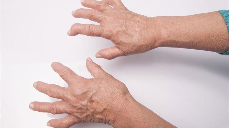 Comprehensive Guide to Recognizing and Managing Rheumatoid Arthritis Symptoms