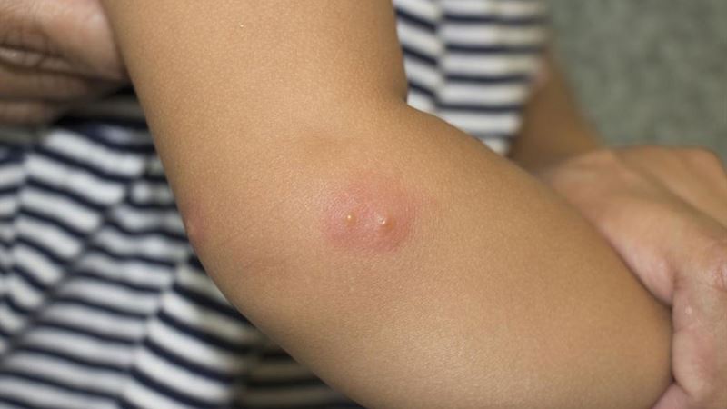 Comprehensive Guide to Managing Shingles: Symptoms, Treatments, and Prevention Strategies