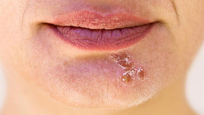 Effective Natural Remedies: Top Essential Oils for Cold Sore Relief