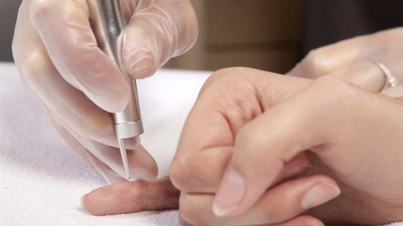 Effective Strategies for Removing Warts Safely and Permanently