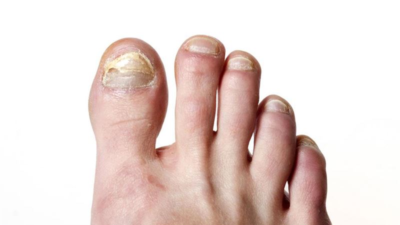 Effective Natural Remedies for Tackling Toenail Fungus: Proven Methods and Tips