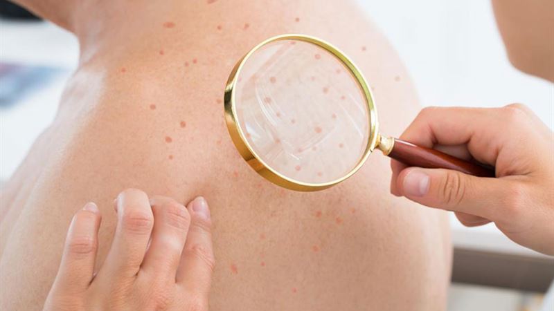 Essential Insights on Staph Infections: What You Need to Know