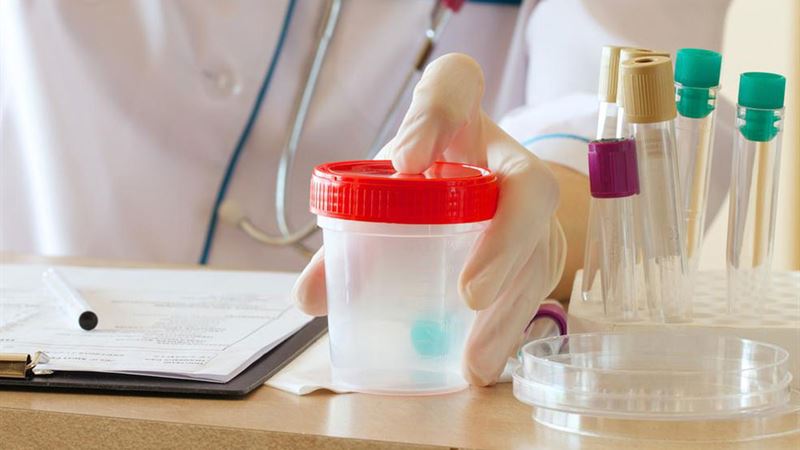 Understanding Proteinuria: Causes, Testing Methods, and What Results Mean