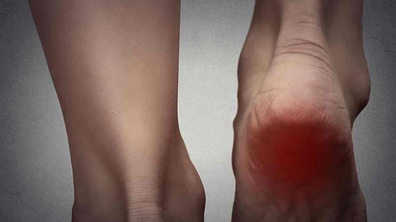 Effective Strategies for Managing Gout Pain and Prevention
