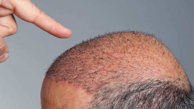 Comprehensive Guide to Hair Transplant Expenses and What You Should Know