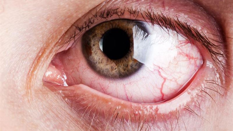 Comprehensive Guide to Causes and Effective Treatments for Persistent Dry Eyes