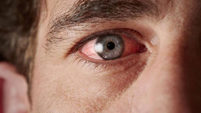 Understanding Sjogren’s Syndrome: Causes, Symptoms, and Management