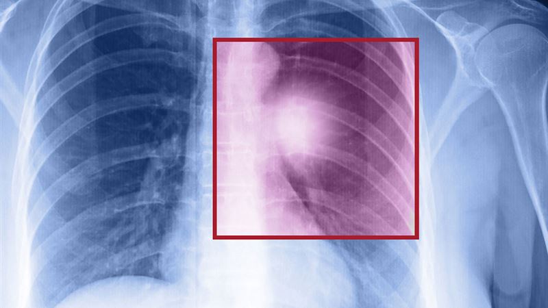 Comprehensive Guide to Lung Cancer: Types, Causes, and Recognizing Symptoms
