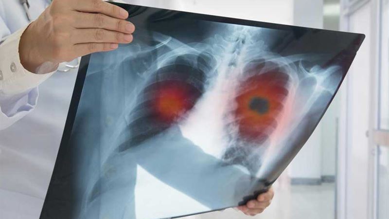 Comprehensive Guide to Pulmonary Fibrosis Management and Treatment Options