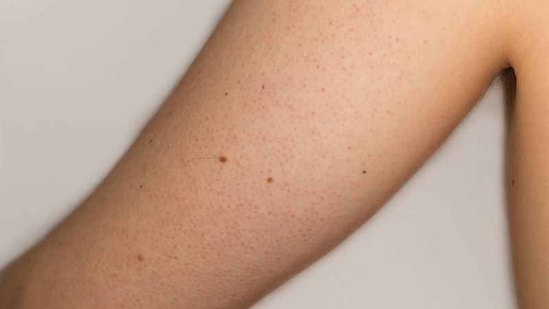 Comprehensive Guide to Effective Management of Keratosis Pilaris