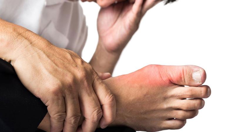 Comprehensive Guide to Gout: Symptoms, Causes, and Effective Treatments