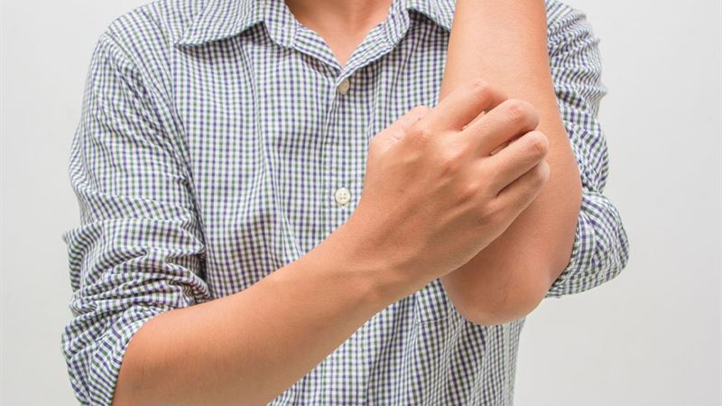 Comprehensive Guide to Jock Itch: Symptoms, Causes, and Effective Treatments