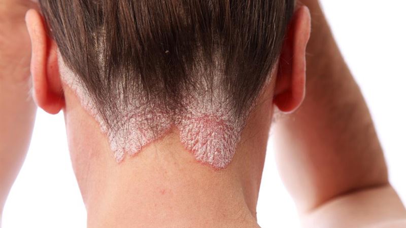 Comprehensive Guide to Scalp Psoriasis: Causes, Symptoms, and Treatment Options
