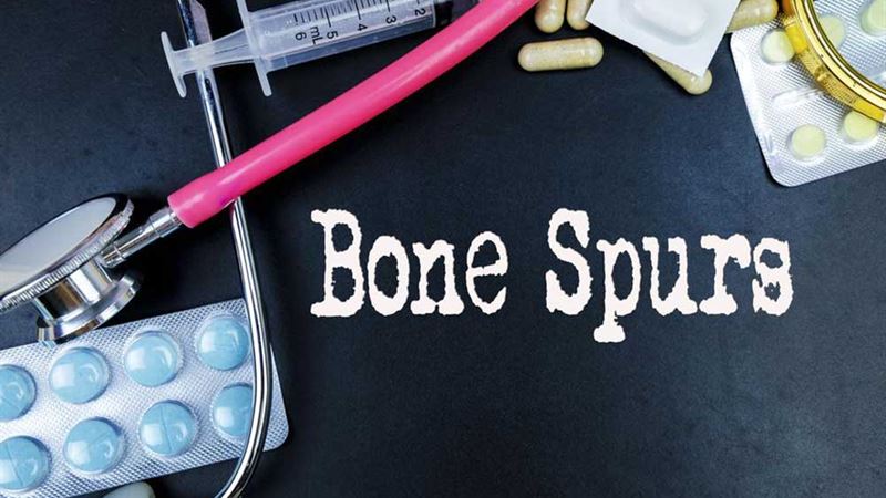 Comprehensive Strategies for Managing and Preventing Bone Spurs