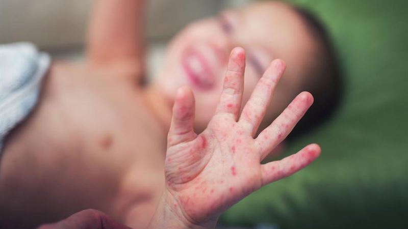 Effective Strategies for Managing and Treating Infant Eczema with Appropriate Skincare Solutions