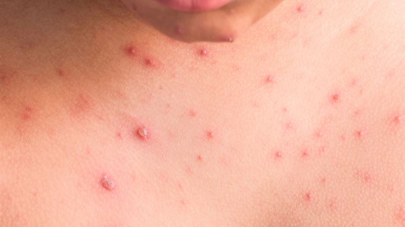 Understanding Tick Bite Rashes: Symptoms, Risks, and Effective Treatments