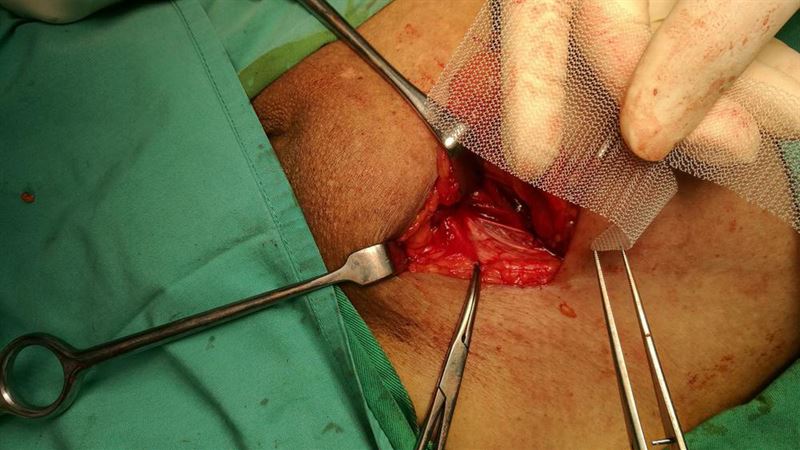 Understanding Umbilical and Femoral Hernias: Symptoms, Causes, and Treatment Options