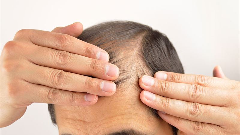 Understanding Hair Loss: Symptoms, Causes, and Factors Leading to Thinning Hair