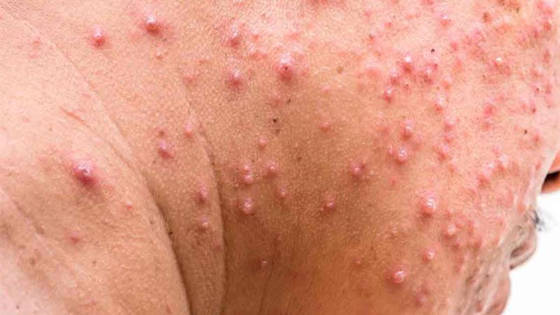 Effective Strategies for Managing and Treating Shingles Outbreaks