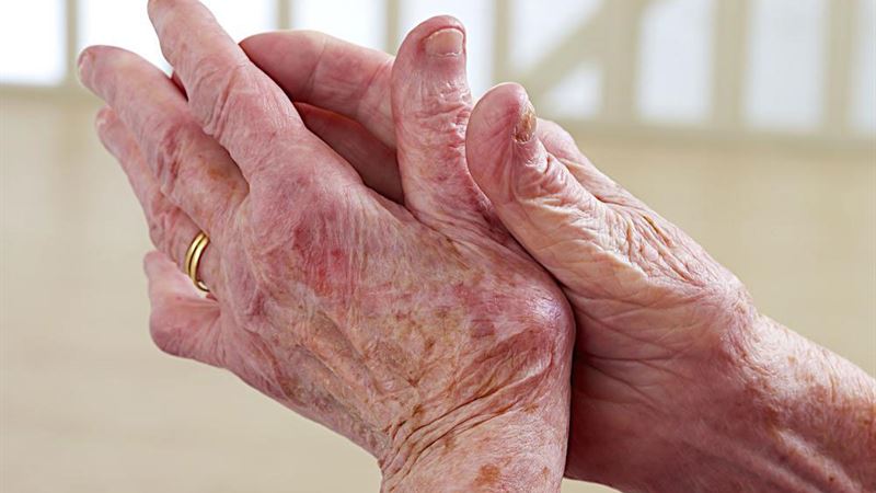 Comprehensive Management and Treatment Strategies for Lupus