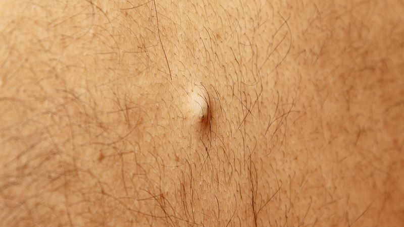 Comprehensive Guide to Recognizing and Managing Ingrown Hair