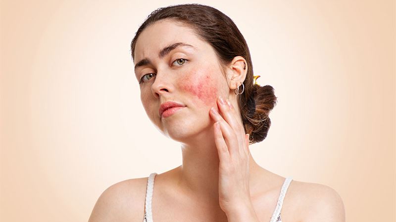 Comprehensive Guide to Rosacea Types and Effective Treatments