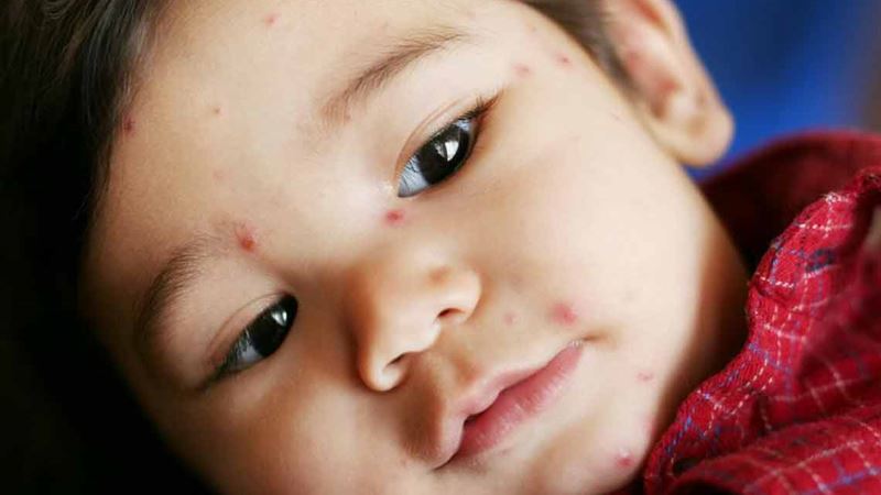 Comprehensive Approaches to Managing and Treating Shingles Naturally and Medically