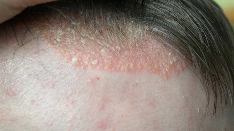 Comprehensive Guide to Recognizing and Managing Scalp Psoriasis